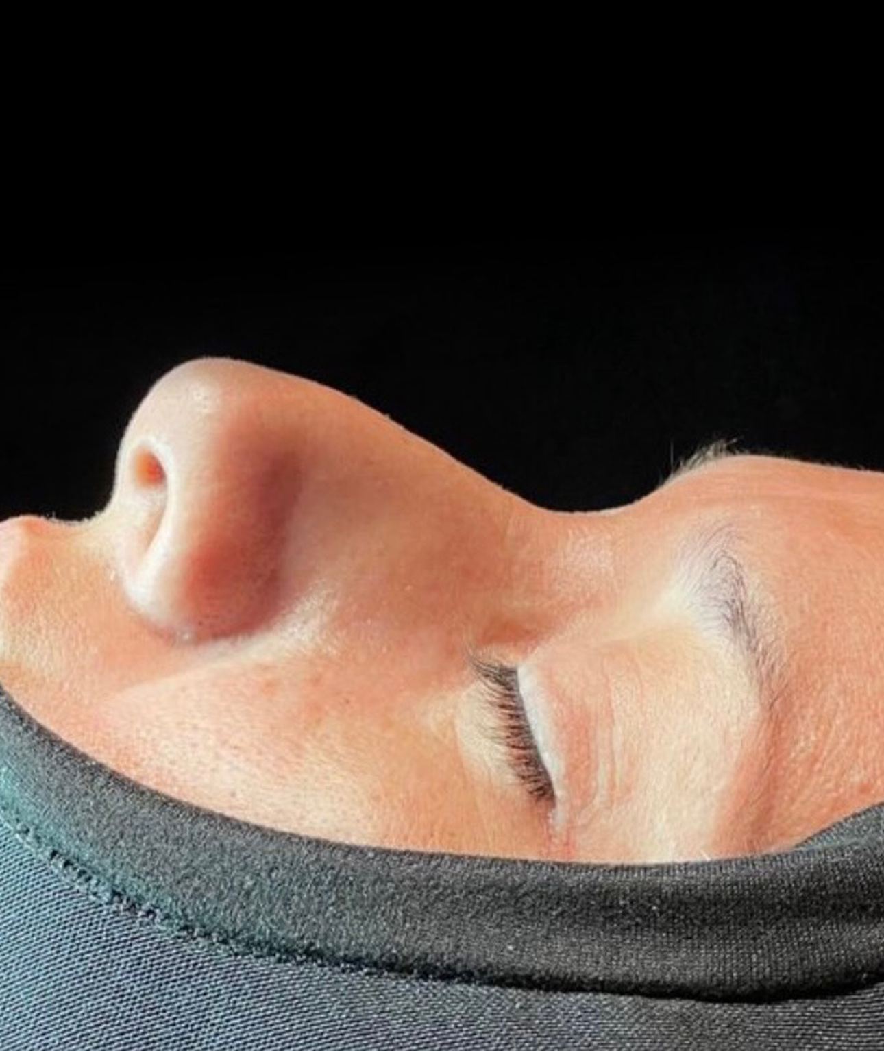Caso 01 — vista lateral antes de rinoplastia