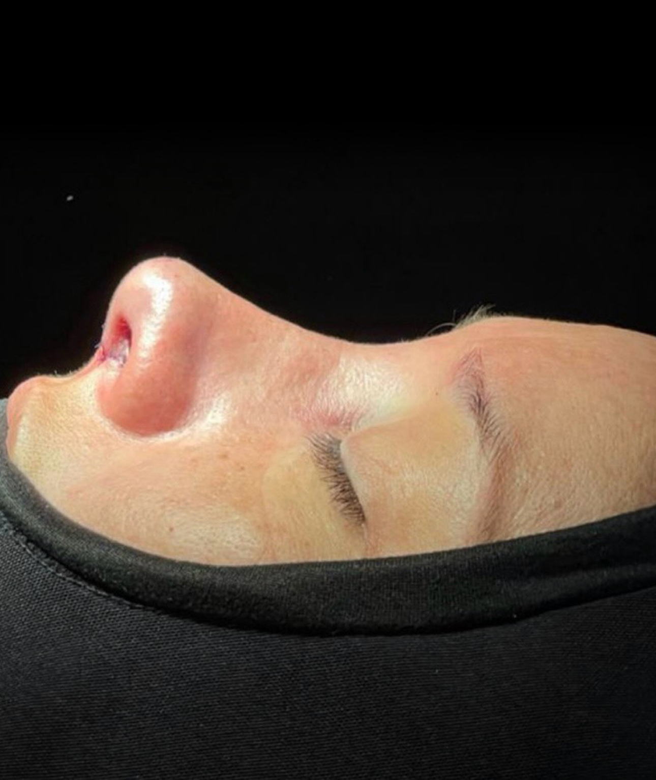 Caso 01 — vista lateral después de rinoplastia